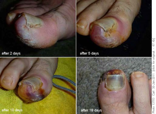 Frostbitten Toe (note that the photos look worse than reality)